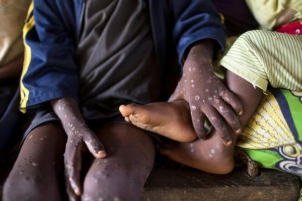 Côte d&#039;Ivoire/Variole du singe : après 2 cas signalés, les autorités sanitaires renforcent les mesures de prévention