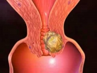 Le cancer du col est le 2&egrave;me cancer f&eacute;minin le plus fr&eacute;quent chez les 15-44 ans en C&ocirc;te d&rsquo;Ivoire, selon le groupe MSD
