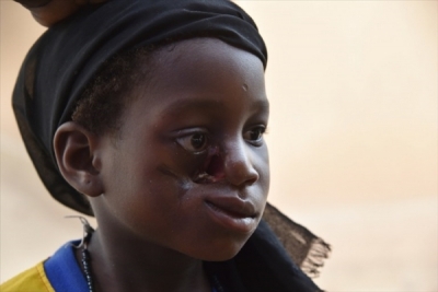 Santé: Le noma, épouvantable maladie de la misère et de la malnutrition