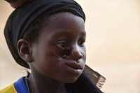 Sant&eacute;: Le noma, &eacute;pouvantable maladie de la mis&egrave;re et de la malnutrition
