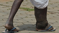 Plus d’un milliard de personnes dans le monde souffrent de maladies tropicales négligées dans le monde (OMS)
