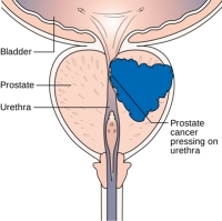 Santé-Cancer de la prostate : Le risque de récidive de la maladie double chez les fumeurs, selon l&#039;Institut Curie
