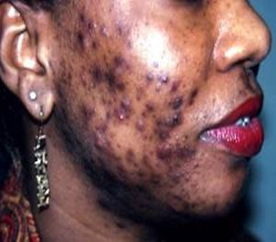 Cosm&eacute;tique : les produits d&eacute;capants d&eacute;sormais interdits en C&ocirc;te d&rsquo;Ivoire