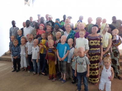 Les albinos de Côte d’Ivoire sollicitent de l’aide pour leurs problèmes de peau