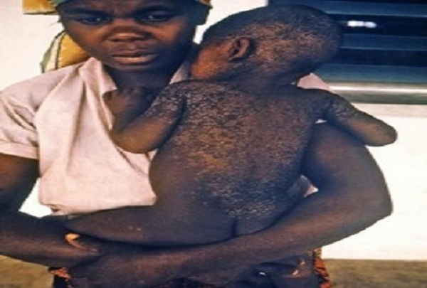 Alerte!!! Une épidémie de rougeole sévit en Guinée, voisin de la Côte d&#039;Ivoire